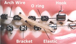 Orthodontic Terms - Orthodontics in South Plainfield, NJ